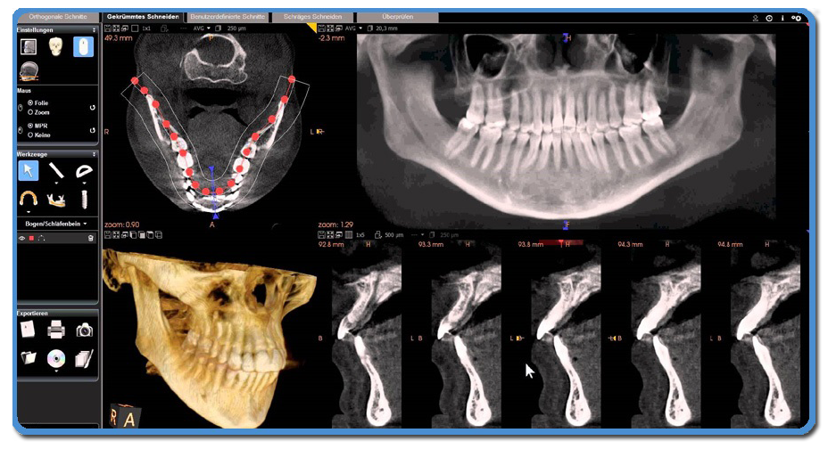 CBCT 3D Dental scanning